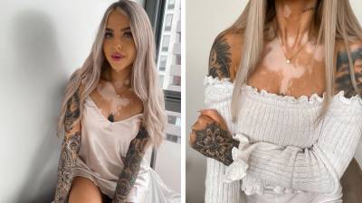 Девушку называли заразной из-за витилиго: как ей помогли татуировки - 24tv.ua
