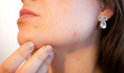 После коронавируса заболевания кожи могут стать хроническими