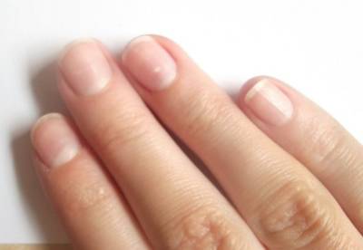Врачи назвали неожиданные признаки диабета, которые видно на ногтях