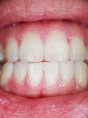 Стоматологи объяснили, как уменьшить чувствительность зубов к холоду