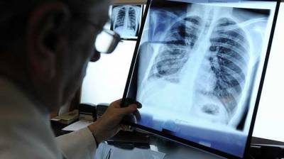Летальность повысилась, поступает молодежь с 80-90% поражения легких, - врач львовской больницы Матолинец о коварности "британского" штамма