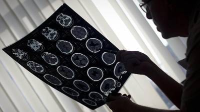 Кардиолог назвал главные признаки надвигающегося тромбоза мозга