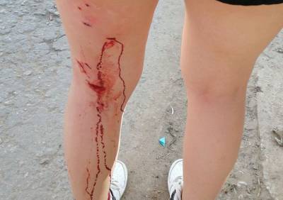 Появились подробности нападения собаки на девочку в Кальном