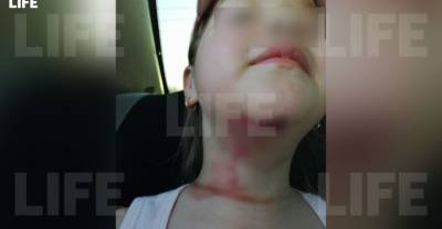 В Омской области шестилетняя девочка чуть не отрезала себе голову в зоопарке