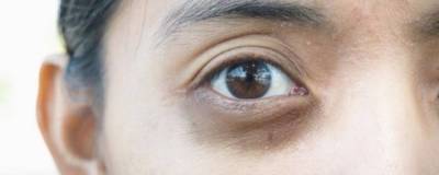 Иммунолог: Темные круги под глазами могут быть симптомом опасных заболеваний