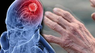 Новое открытие ученых: первым сигналом болезни Паркинсона назвали низкий кровоток в головном мозге – Учительская газета