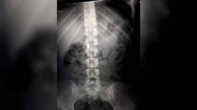 Из желудка томского подростка врачи достали 4 магнитных цилиндра