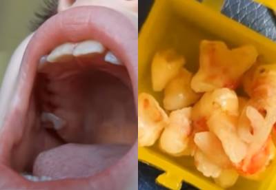 9-летней украинке вырвали 12 зубов одним махом: мама говорит, что согласие не давала