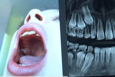 Под Киевом стоматологи удалили девочке сразу 12 зубов