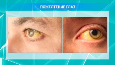 Офтальмолог объяснил, почему желтеют глаза