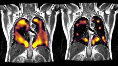 Признаки долгого ковида наконец удалось увидеть на МРТ лёгких
