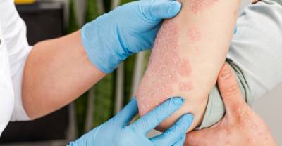 Иммунолог предупредила россиян об эпидемии аллергических заболеваний