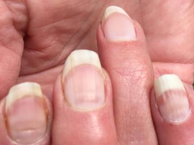 Ученый назвал способ выявить COVID-19 по состоянию ногтей