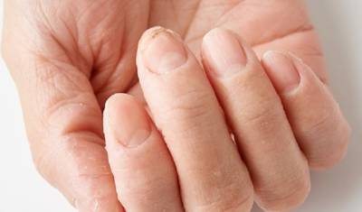 Коронавирус можно «вычислить» по состоянию ногтей