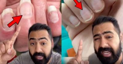 Врач на видео раскрыл, как по одному взгляду на ногти понять, мог ли пациент уже переболеть CoViD