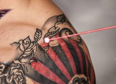 Удаление татуировки лазером: что полезно знать