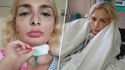 Москвичке порезали легкое и изуродовали нос во время пластической операции
