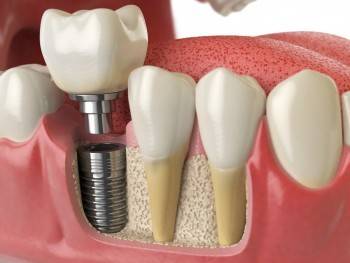 Что такое имплантация зубов и где ее делают в Вологде