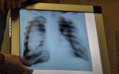 Не радіація і не екологія: лікарі назвали головну причину виникнення раку - піддаються всі