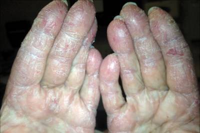 Как лечиться при дерматомиозите – загадочном заболевании кожи и мускулатуры