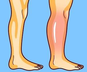 3 простых упражнения от остеопата для снятия отеков ног