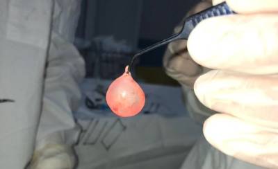 В Челябинске хирурги удалили огромную опухоль из глаза четырехмесячного малыша