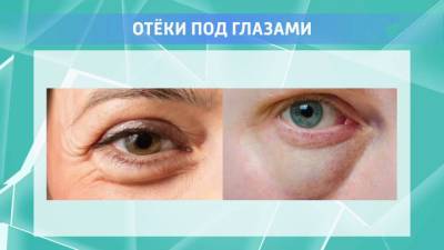 Вениамин Смехов - Опухшие глаза: как избавиться от отеков - vesti.ru