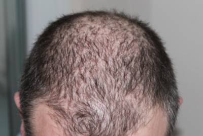 Врач-трихолог предупредила о длительном выпадении волос после коронавируса