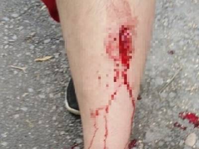 В Челябинской области девочка ранила ногу, спускаясь по лестнице