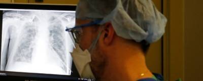 Британские врачи назвали неочевидные симптомы рака легких