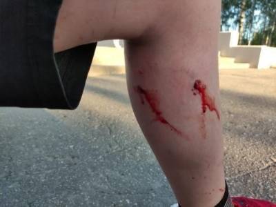 Собаки напали на юного рязанца в Мемориальном парке Рязани