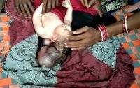 В Индии родился младенец с тремя головами