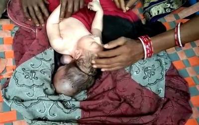 В Индии родился трехглавый ребенок