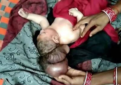 В Индии родился трехголовый младенец
