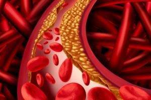 Эруптивный ксантоматоз: врачи назвали еще один симптом опасного холестерина
