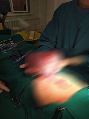 В Тюмени хирурги извлекли из живота ребенка 25-сантиметровую опухоль в форме сердца