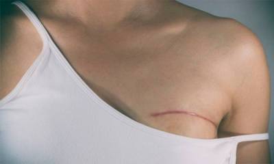 Проснулась без груди: в Харькове врачи без предупреждения ампутировали женщине молочную железу