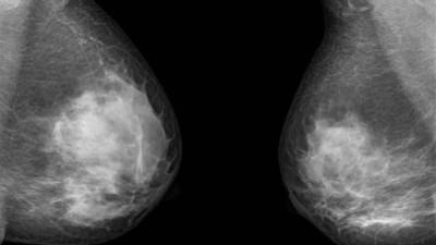 Революционный метод лечения рака груди открыли ученые