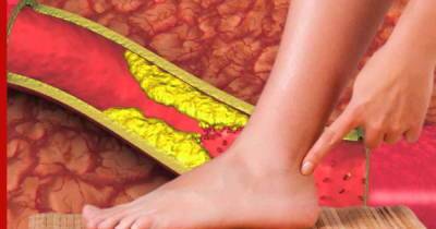 Высокий холестерин: ранний признак на ногах, сигнализирующий об опасном состоянии