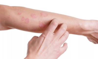Тюменцы опробуют новые методы лечения кожных заболеваний