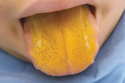Редкое заболевание окрасило язык мальчика в ярко-желтый цвет