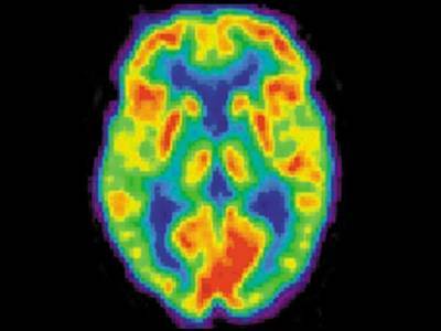 Нейросеть способна обнаруживать на томограммах мозга патологии, вызывающие эпилепсию