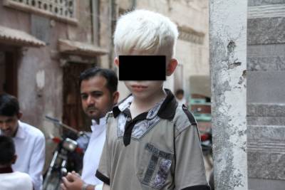 Возросло убийство людей с альбинизмом для использования тел в магии