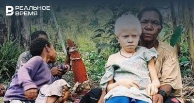 ООН сообщила о росте количества убийств людей с альбинизмом из-за пандемии