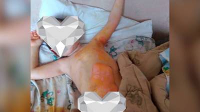 В Челябинской области мать не пускала врачей к 4-летнему ребенку с ожогами