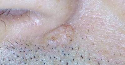 Это не укус комара: 7 признаков рака кожи, на которые никто не обращает внимания