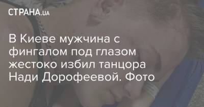 В Киеве мужчина с фингалом под глазом жестоко избил танцора Нади Дорофеевой. Фото