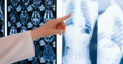 Пульмонолог оценил шансы на выживание пациентов с раком лёгкого