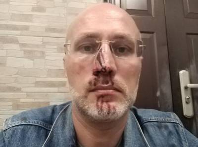 Сломали нос и прыснули в глаза: петербуржец рассказал, как его пытается выселить из квартиры бывшая жена