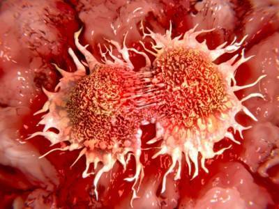Ученые назвали признаки одного из самых агрессивных видов рака